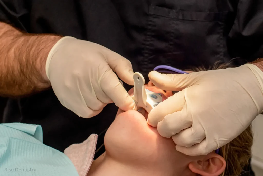 how long does dental bonding take