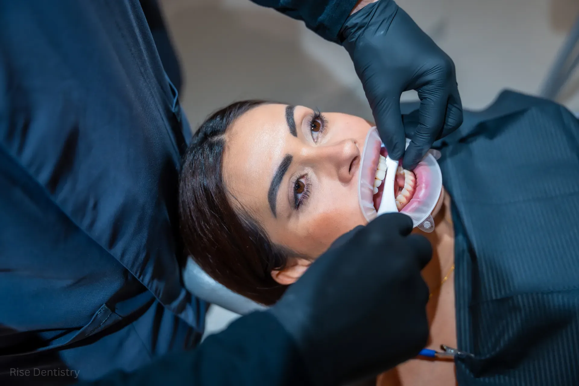 how much is dental bonding