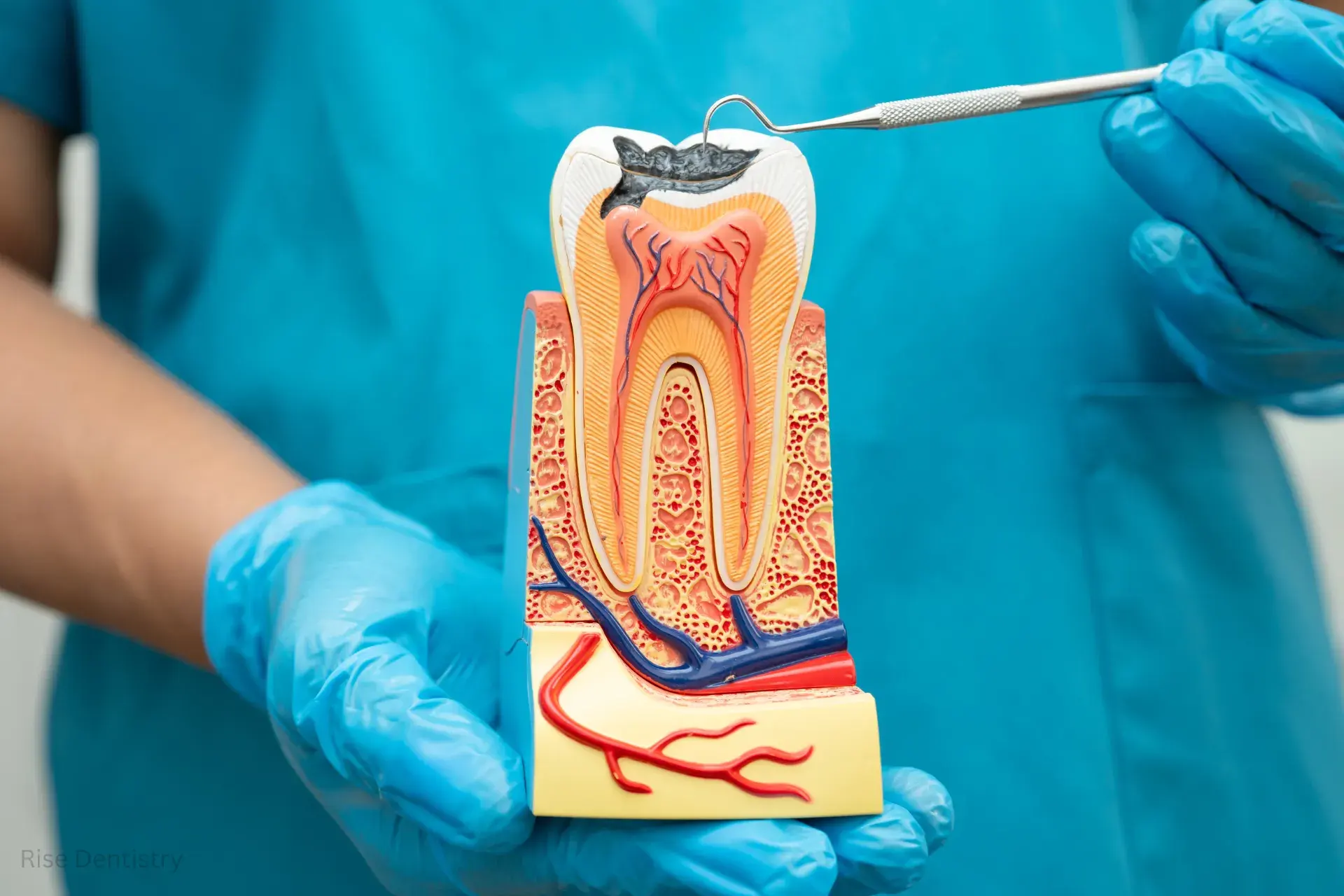 pulpotomy vs root canal