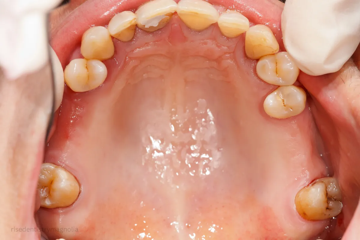 root canal discomfort