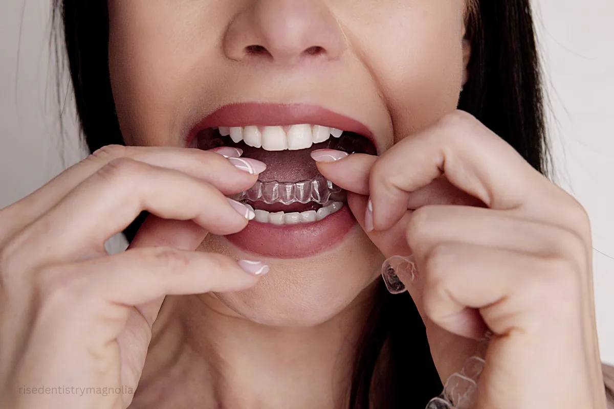 timeline for overbite correction with clear aligners