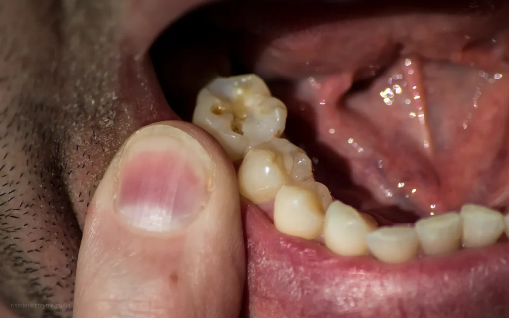 what causes root canal