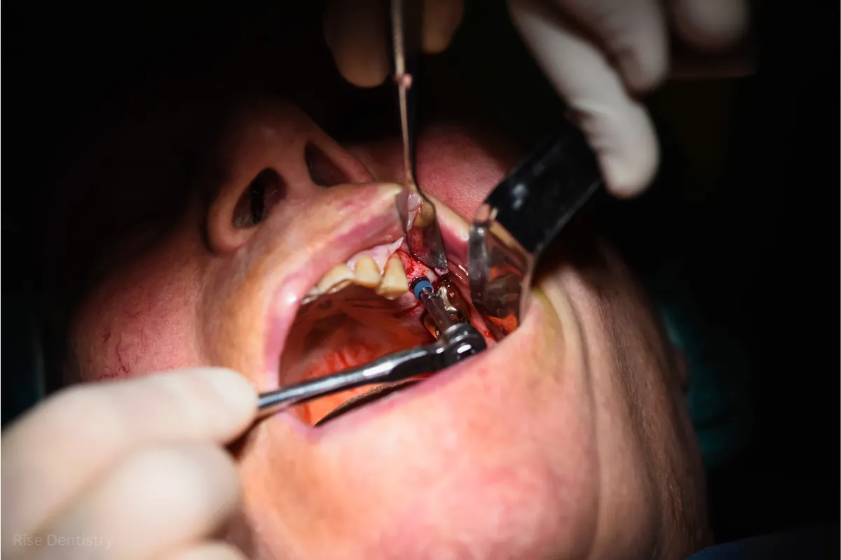 why do you need a tooth extraction