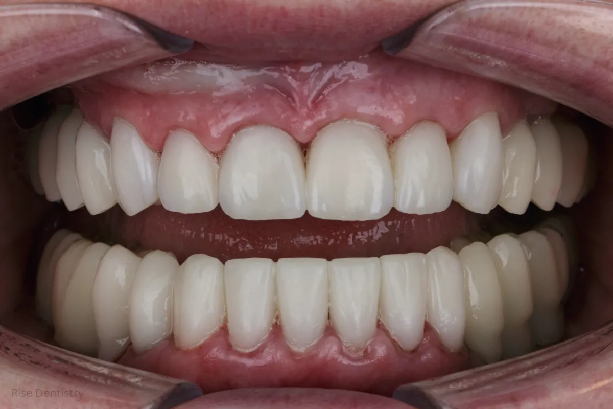 average cost of crown tooth