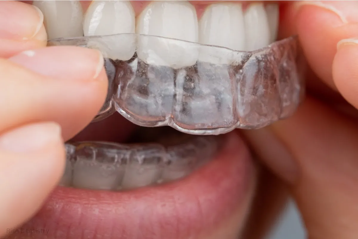 clear aligners vs invisalign price