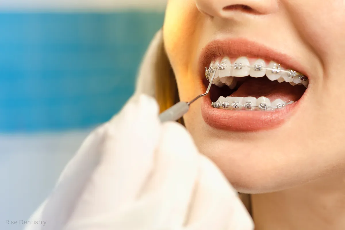 dental bridge vs dental implant