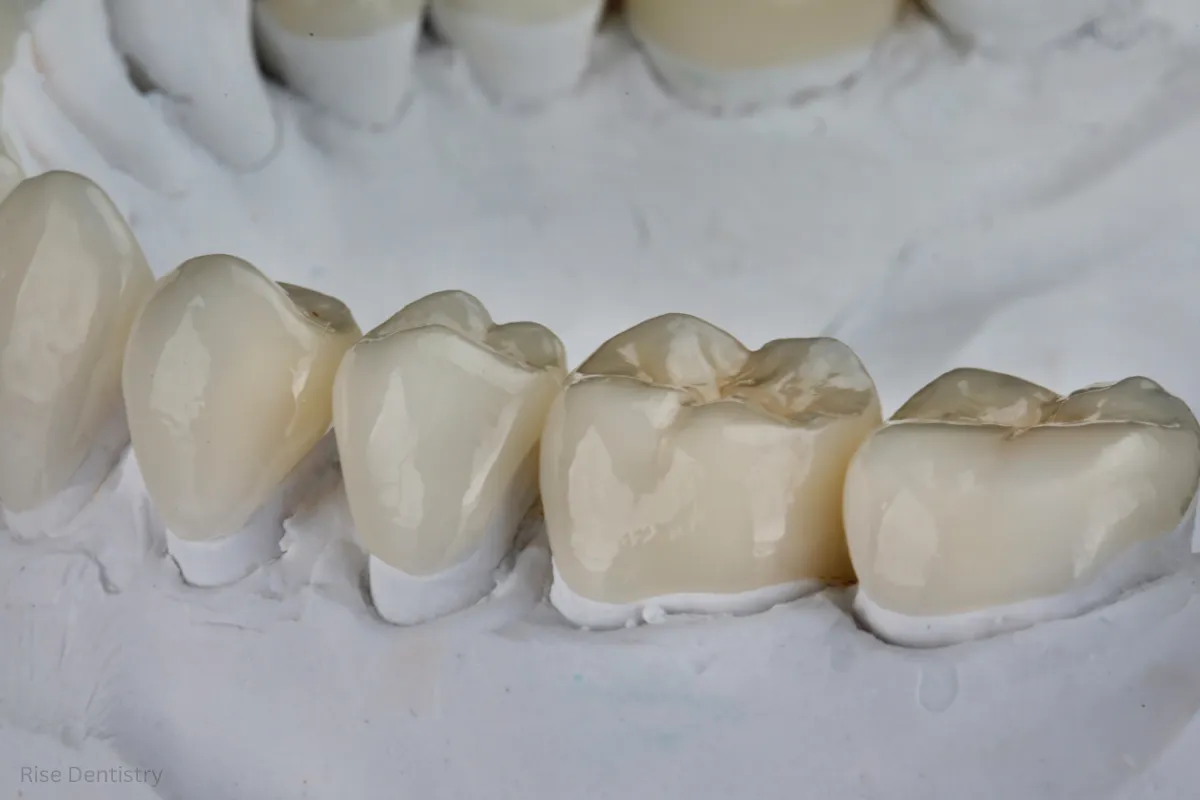 dental crown recovery