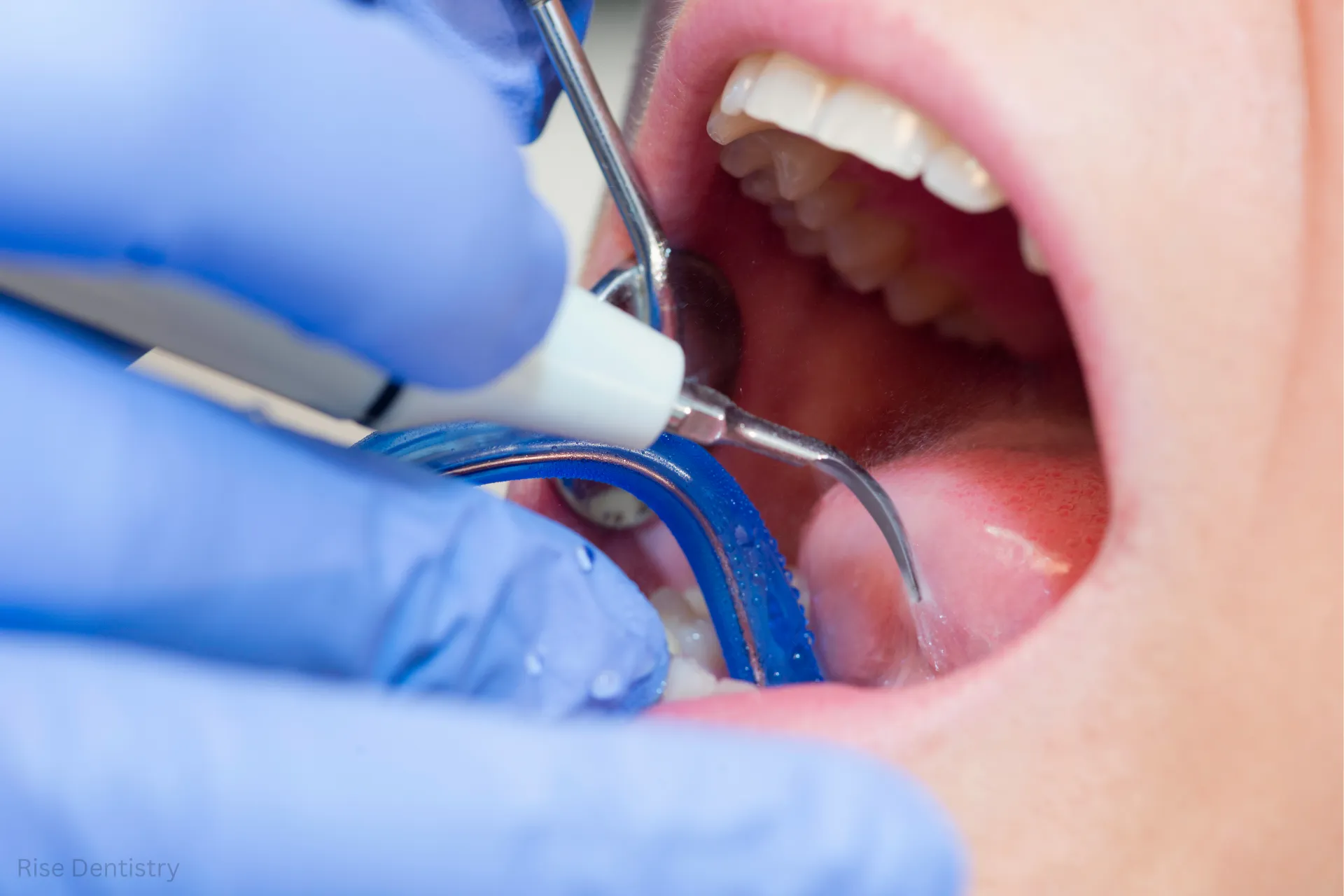 how long do dental fillings last