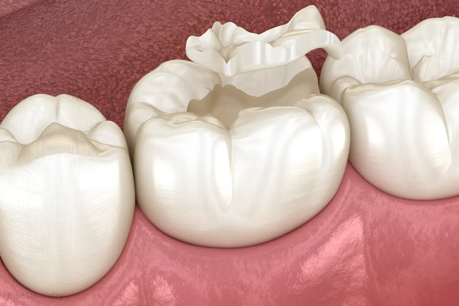 how long does it take to crown a tooth