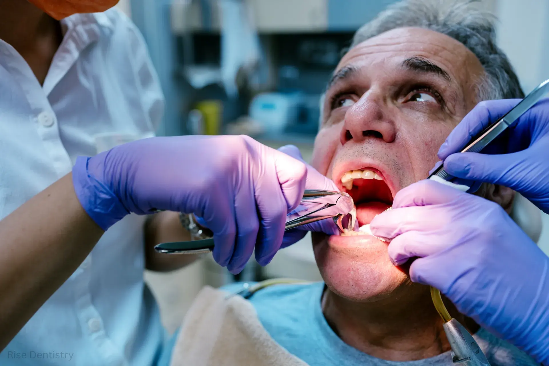 how long does swelling last after tooth extraction