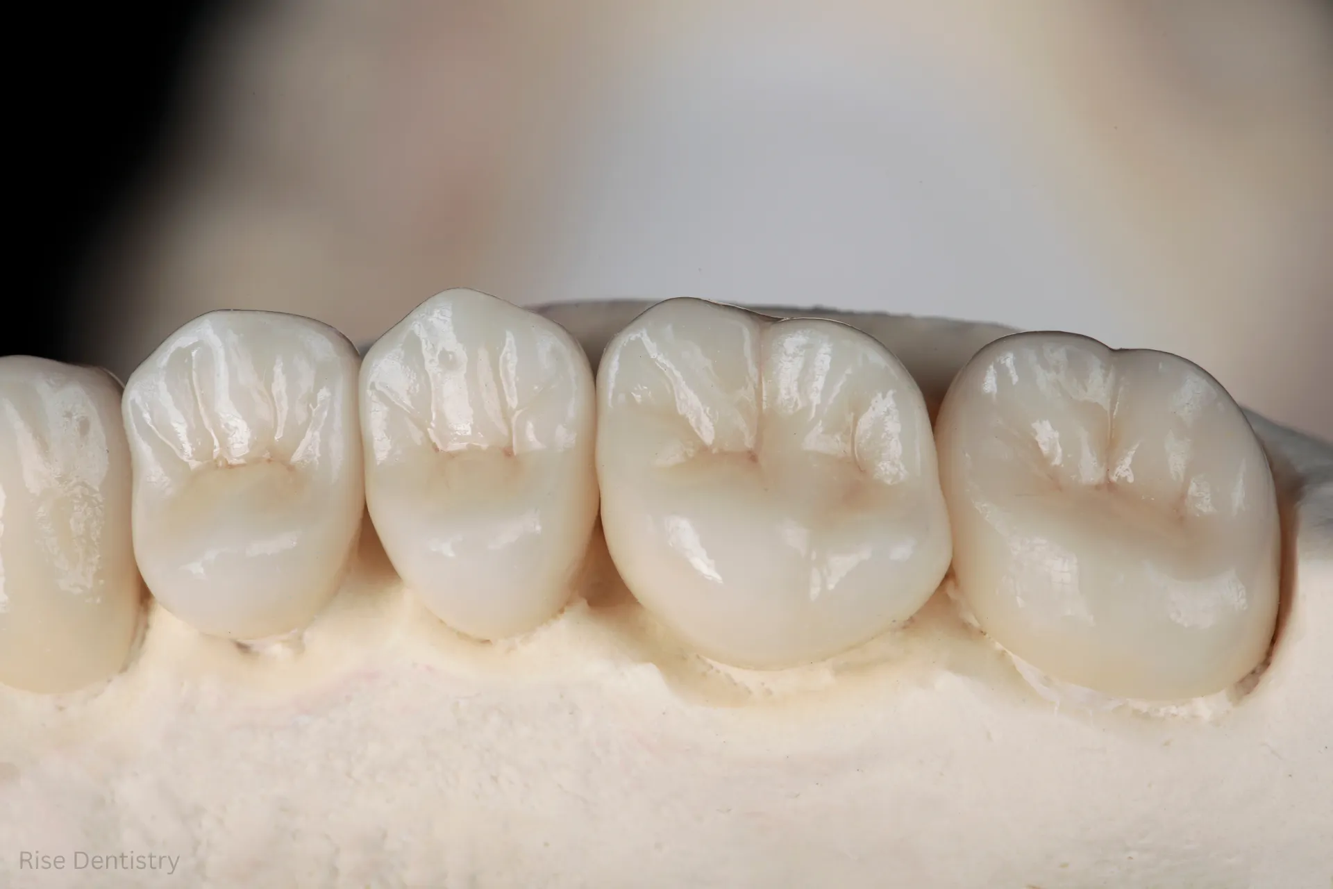 how much does a dental bridge cost