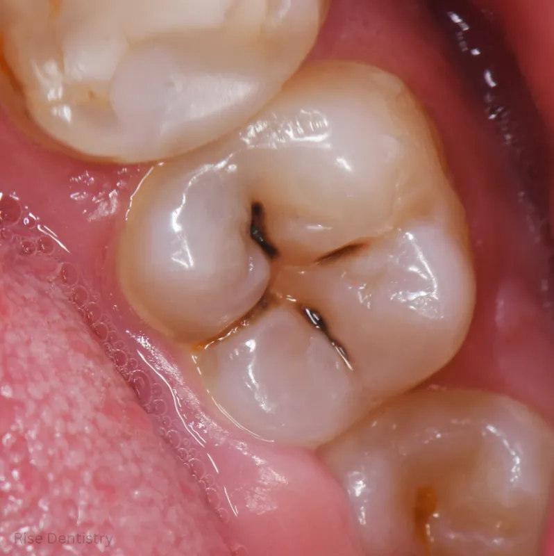 tooth crown fitting