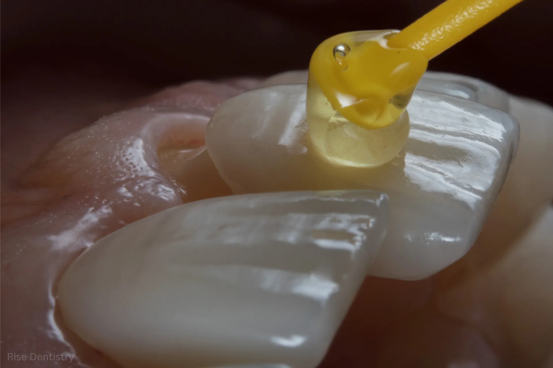 tooth crown vs veneer