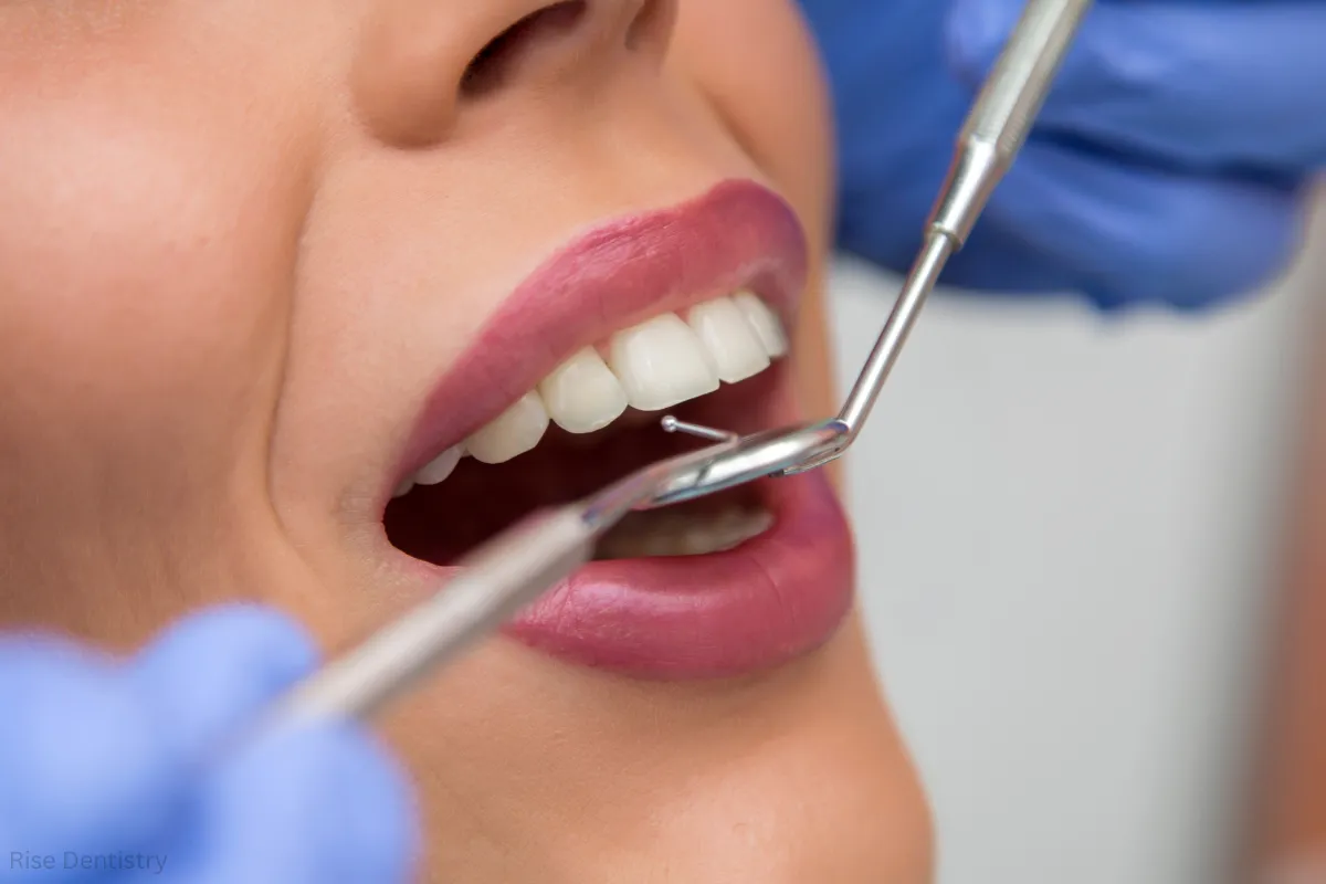 what are dental fillings