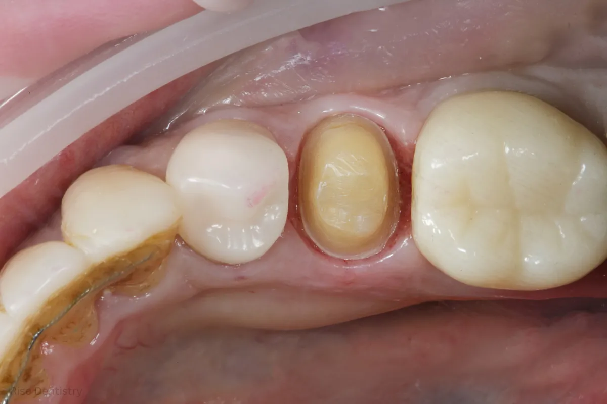 what is a crown procedure