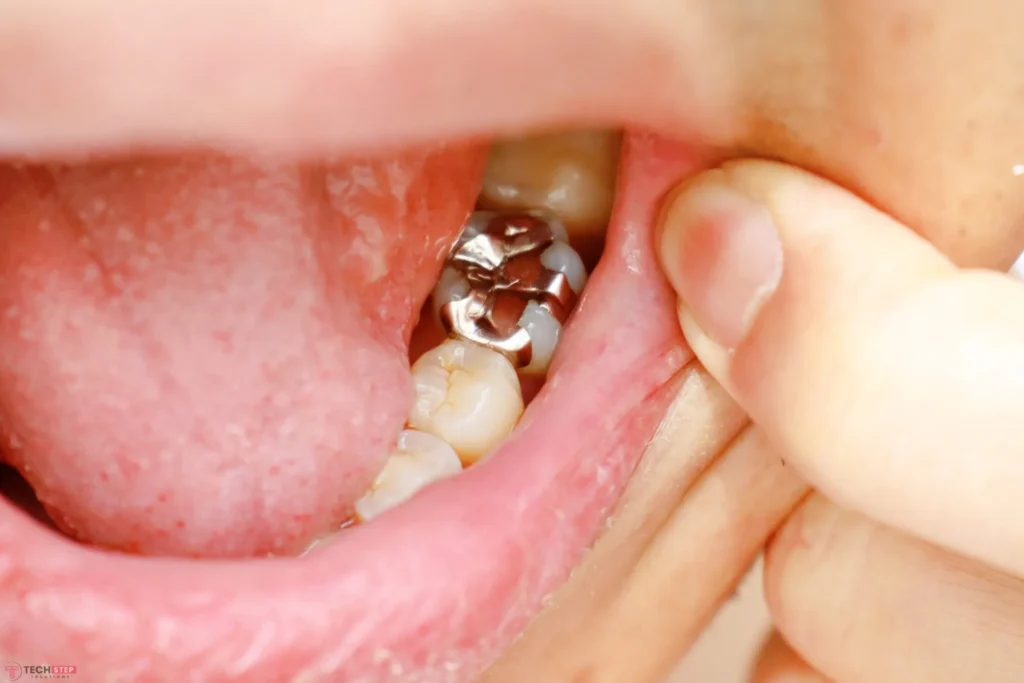 how long does it take to get a dental filling