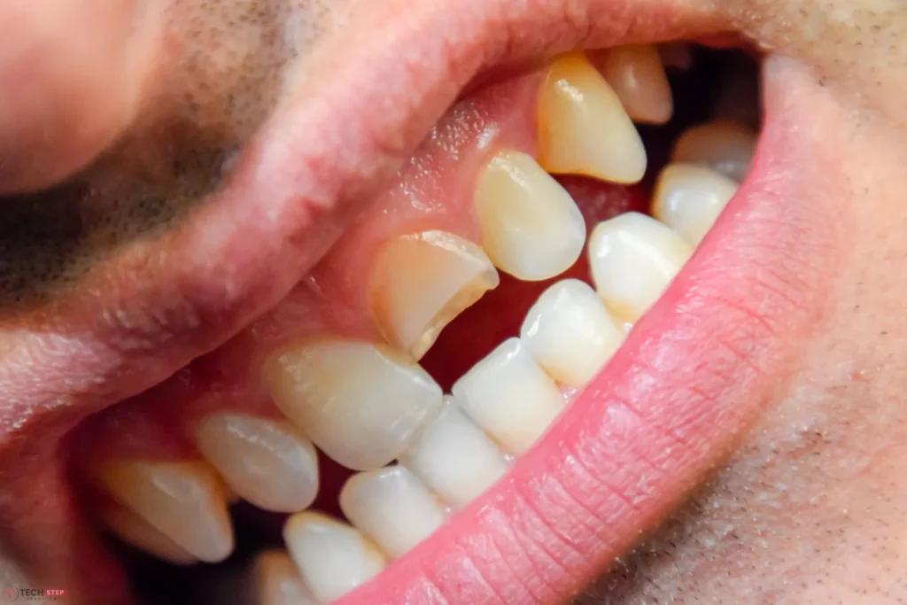 broken tooth emergency when should you see a dentist