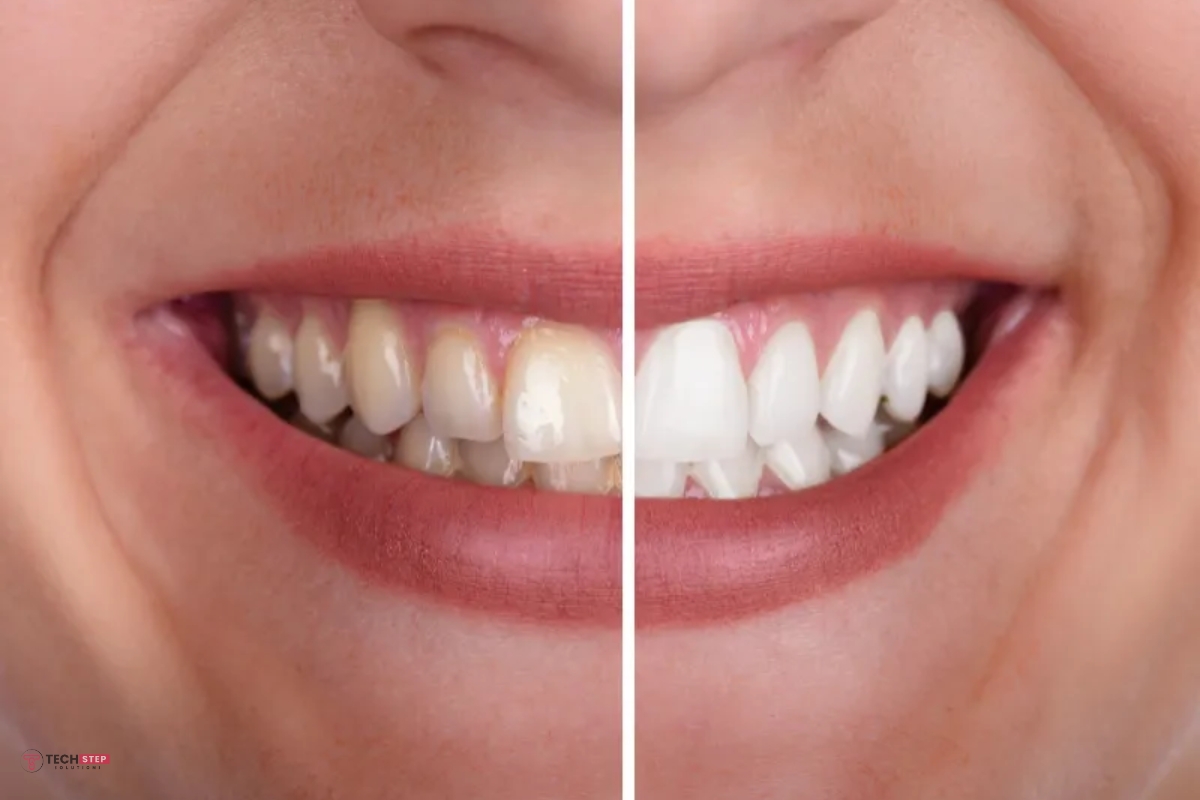 Benefits of Porcelain Veneers