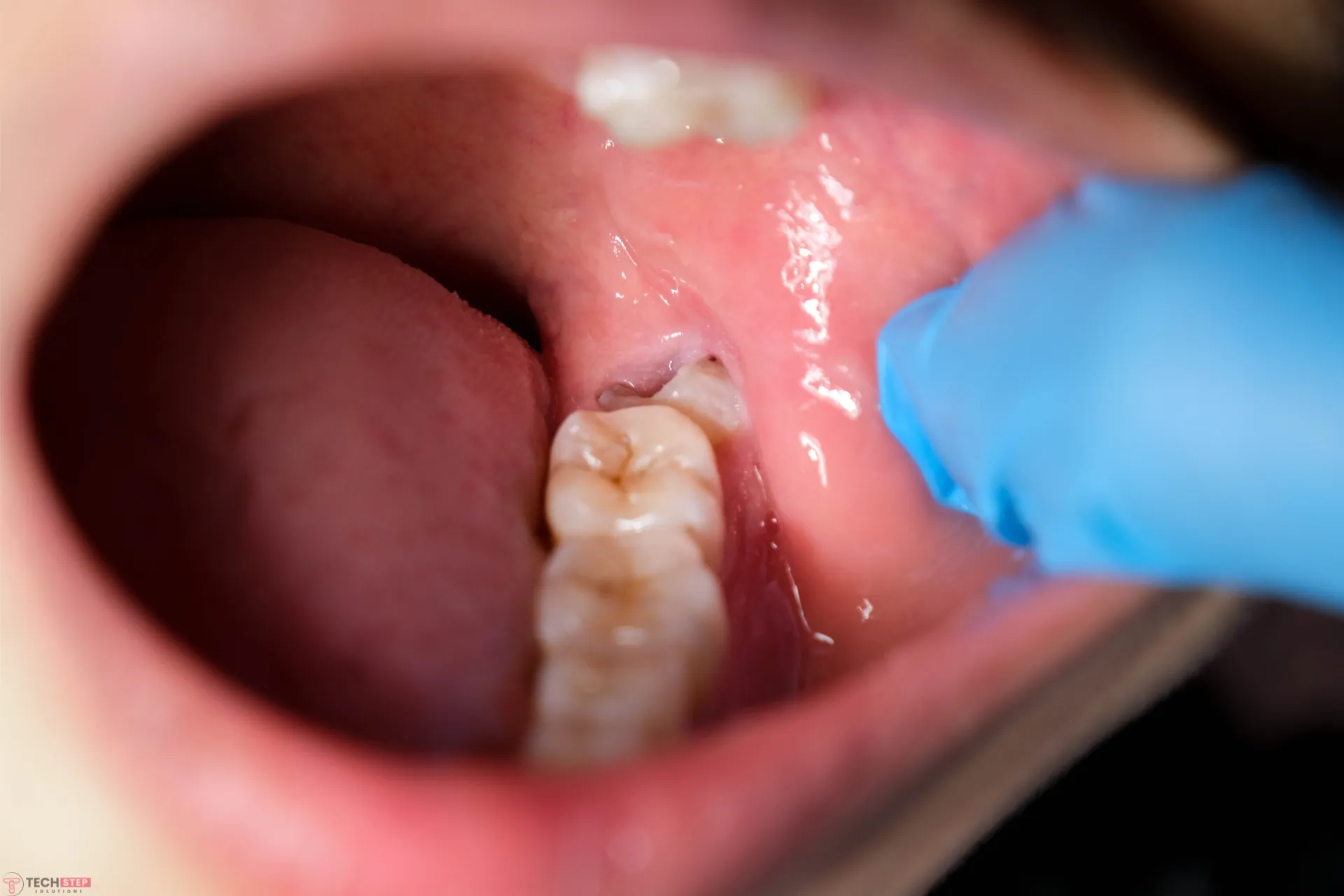 Does Wisdom Teeth Removal Hurt