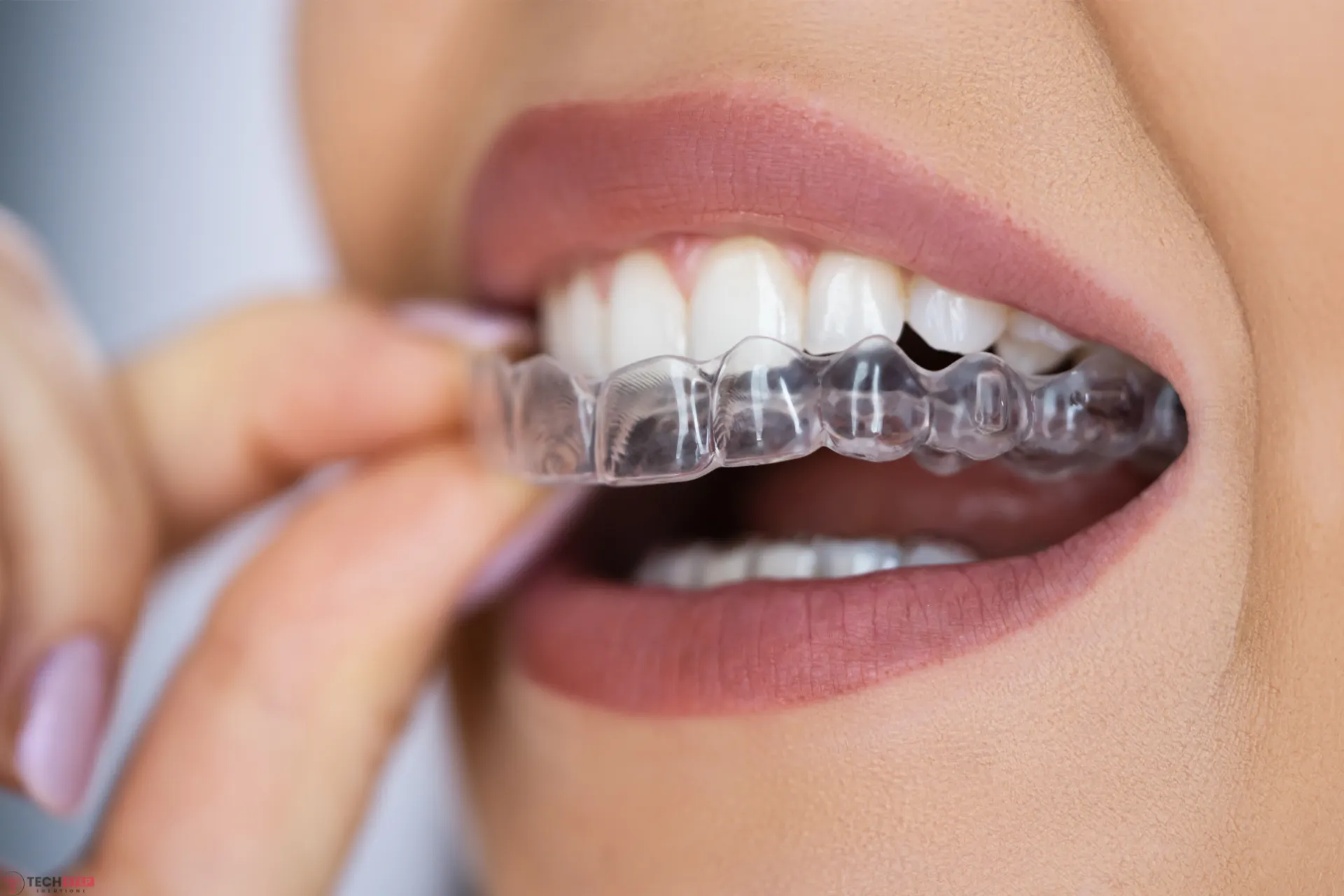 How Much Do Clear Aligners Cost