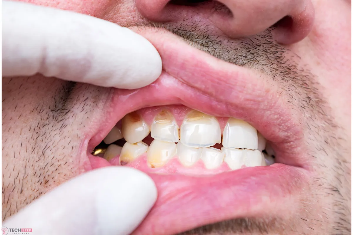 chipped tooth repair cost