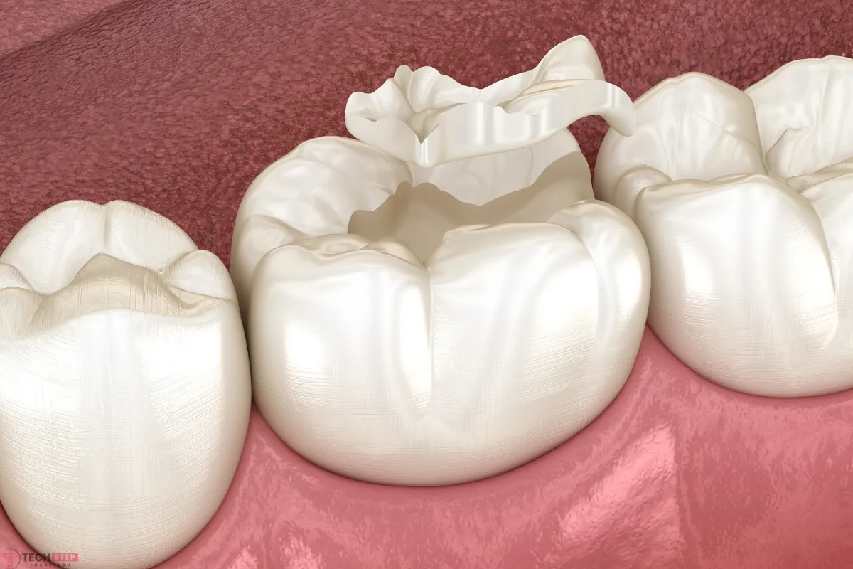 root canal and crown